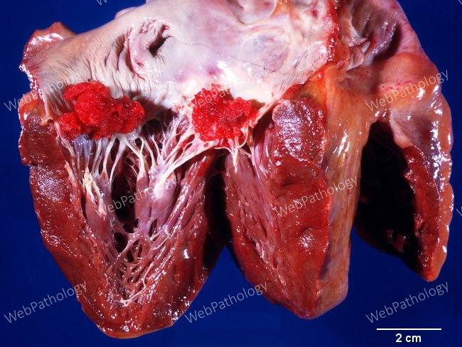 Heart_Endocarditis_NonBacterialThrombotic9A_TricuspidMitral (1).jpg